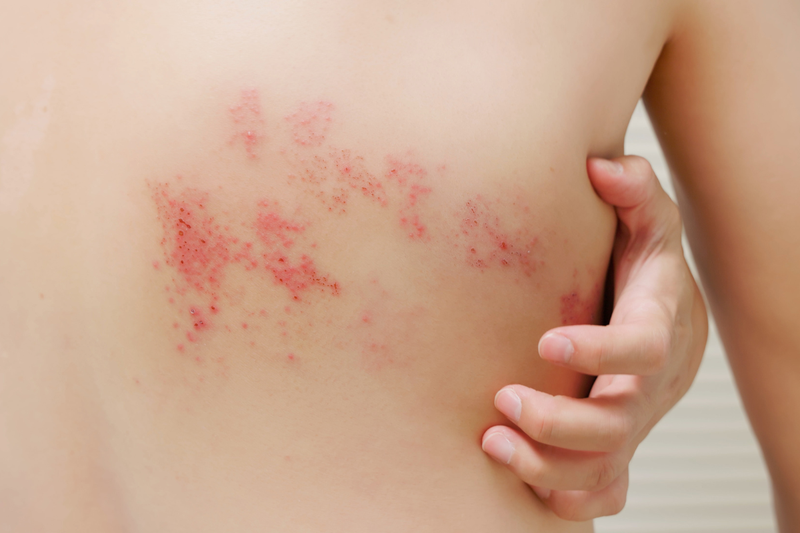 Shingles Symptoms rash on woman's back