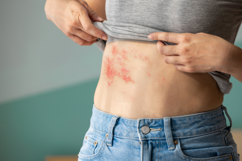 Shingles symptoms rash on woman's stomach
